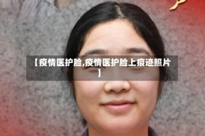 【疫情医护脸,疫情医护脸上痕迹照片】