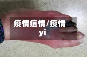 疫情疽情/疫情yi